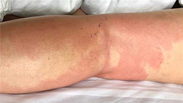 Воспаление при целлюлите.jpg