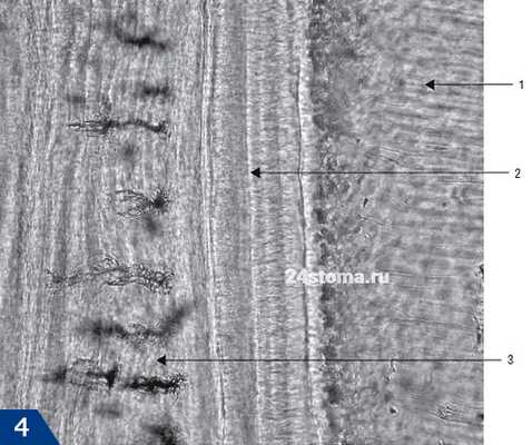 Слои цемента (электронная микроскопия), где 1 - дентин, 2 - бесклеточный цемент, 3 - клеточный цемент.
