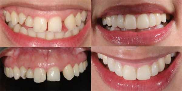 Идеальные, но временные: роль временных реставраций