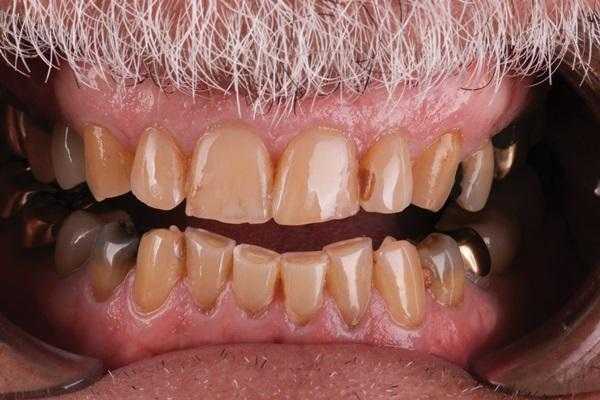 Постоянство временных: провизорные коронки как этап ортопедической реабилитации