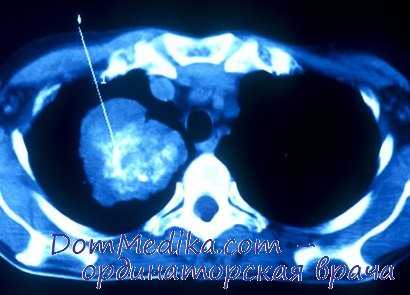 диагностика рака легкого