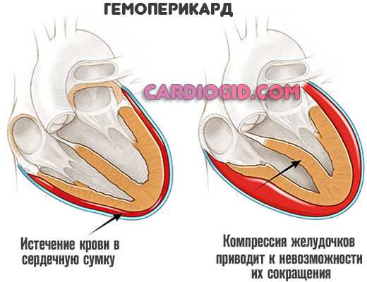 гемоперикард