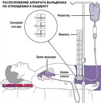 аппарат-Вальдмана