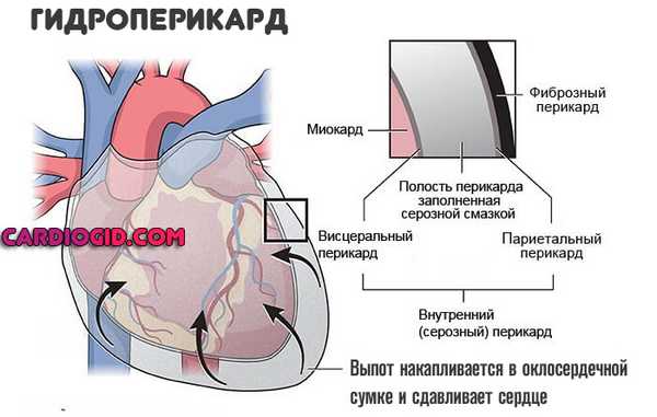 гидроперикард
