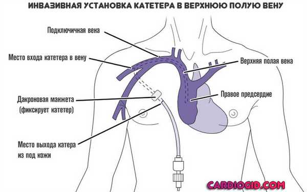 установка-катетера