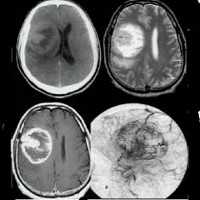 Церебральный глиоматоз