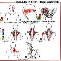 Цервикокраниалгия