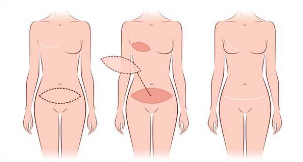 схема восстановления груди за счет своего живота