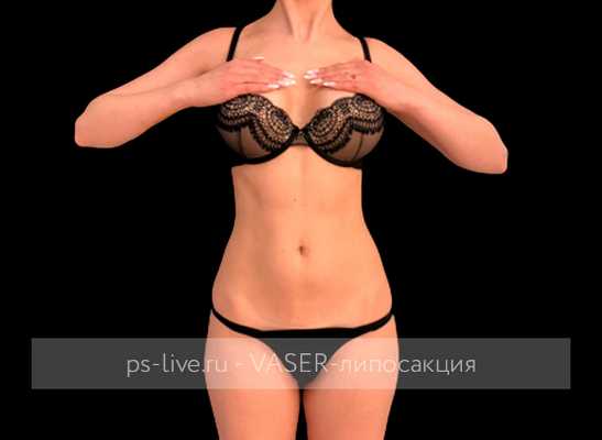 фото до Вайзер-липосакции