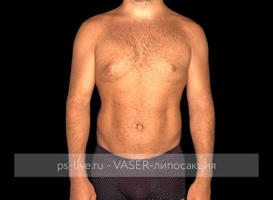 фото до Вайзер-липосакции