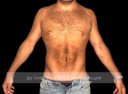 фото после Вайзер-липосакции