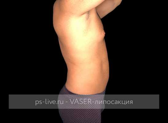 фото до Вайзер-липосакции