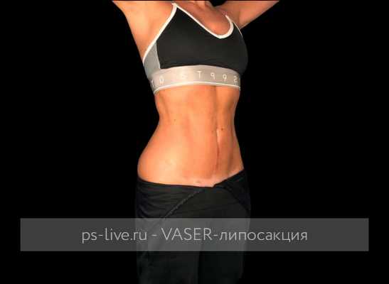 фото после Вайзер-липосакции