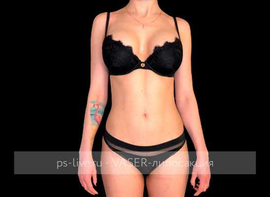 фото после Вайзер-липосакции