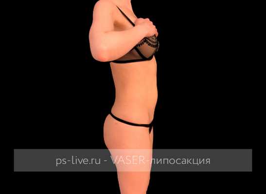 фото до Вайзер-липосакции
