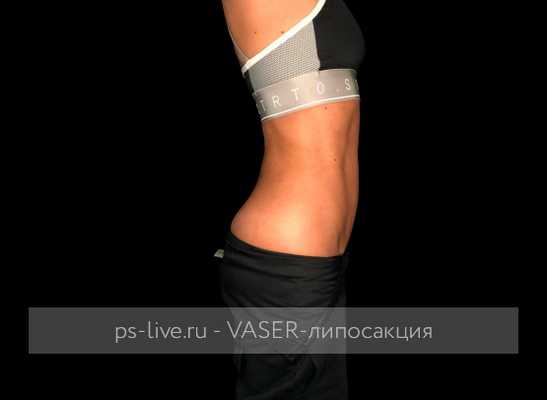 фото после Вайзер-липосакции
