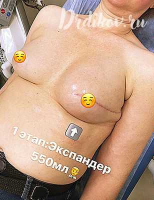 Реконструкция груди - 1 этап:Экспандер 550мл