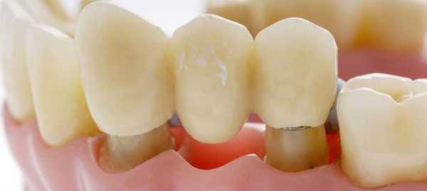 Мостовидный протез