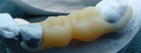 Иммедиат-протезы