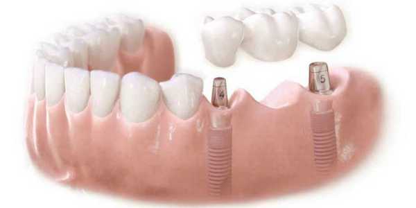 Протезирование на имплантатах