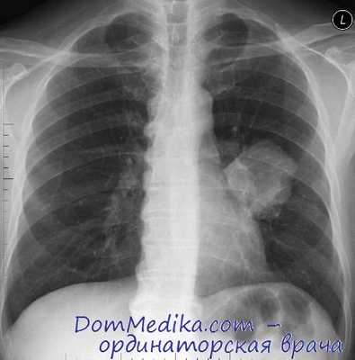 рак легкого