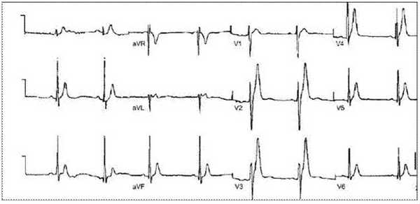 Синдром укороченного интервала QT