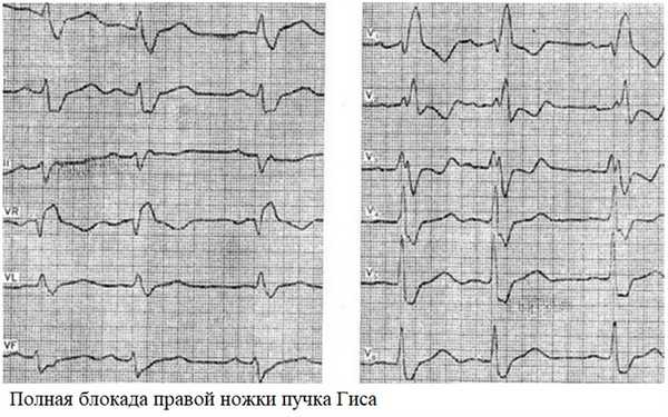 Полная блокада правой ножки пучка Гиса