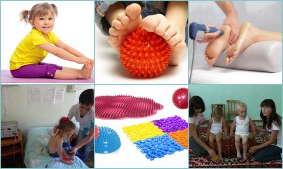 ЛФК и физиотерапия при х-образных ногах