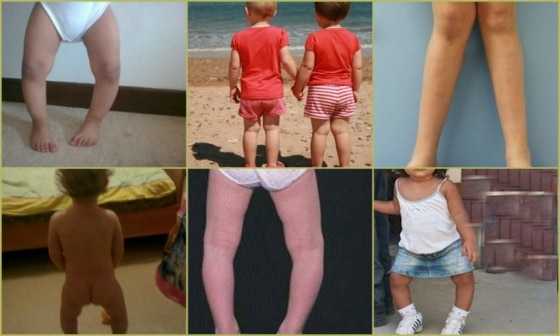 Разновидности деформаций ног у детей