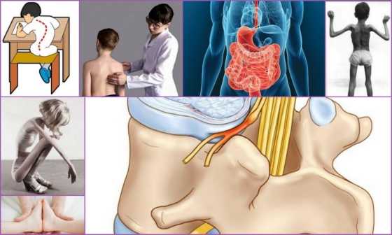 Последствия Х-образной деформации