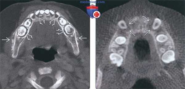 Лучевая диагностика изменений челюсти при лейкозе