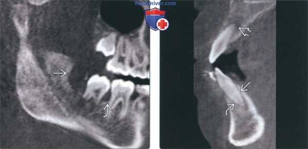 Лучевая диагностика изменений челюсти при лейкозе