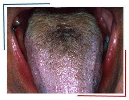 Гипертрофия сосочков языка (черный волосатый язык). Источник: http://www.medscape.com