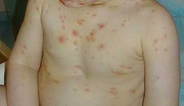 Фото Чесотка у детей