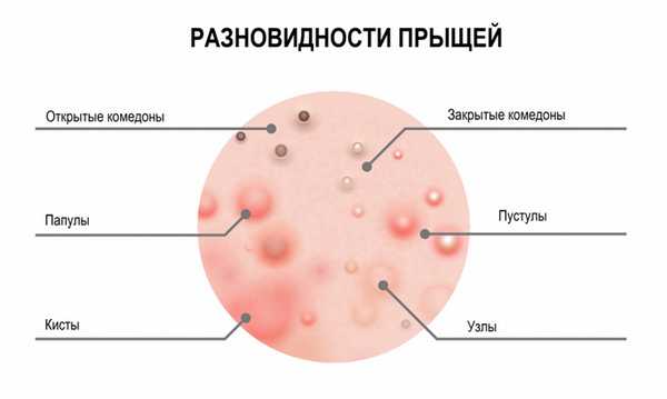 Разновидности прыщей.jpg
