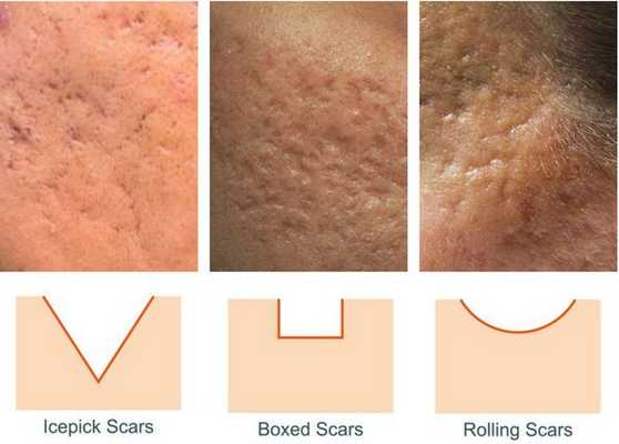 Формы атрофических рубцов