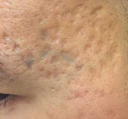 Квадратные рубцы