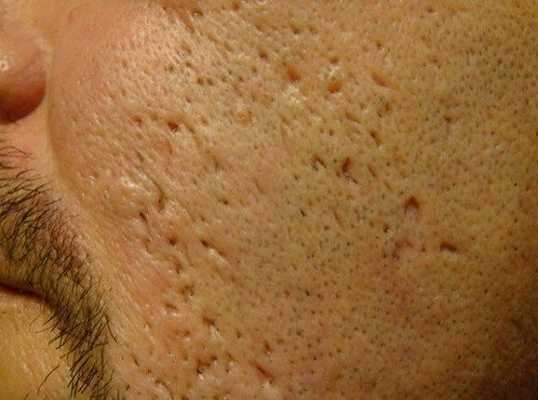 Сколотые рубцы