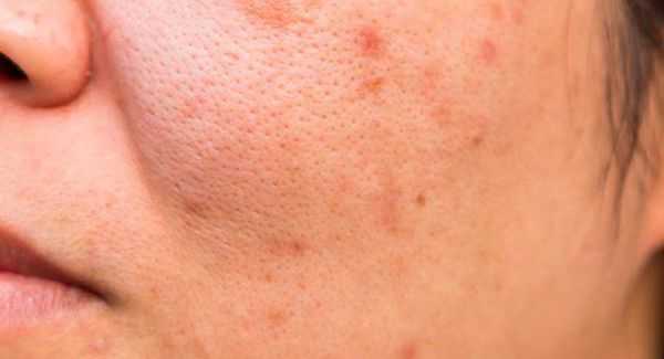 Поствоспалительная эритема