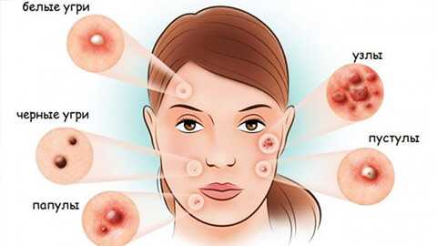 акне виды