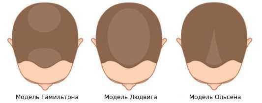 Модели андрогенетической алопеции