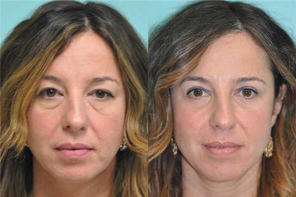 показания к блефаропластике