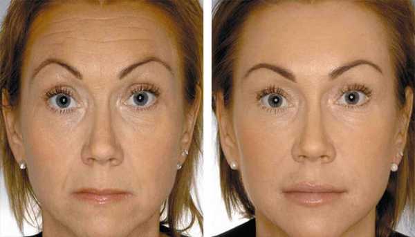 Диспорт до и после.jpg