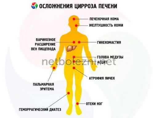 Осложнения заболевания печени