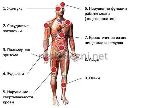Основные симптомы цирроза