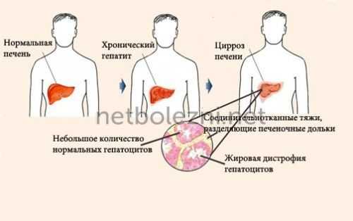 Что приводит к циррозу
