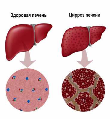 цирроз.jpg