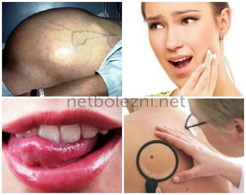 Внешние характерные признаки болезни