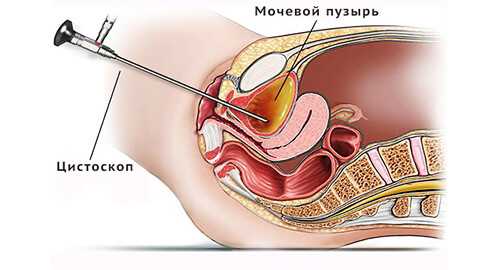 цистит