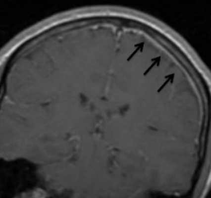 Менингит на МРТ